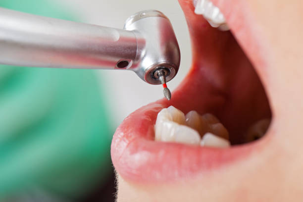 Best Emergency Root Canal Treatment in Shelbyvle, IL